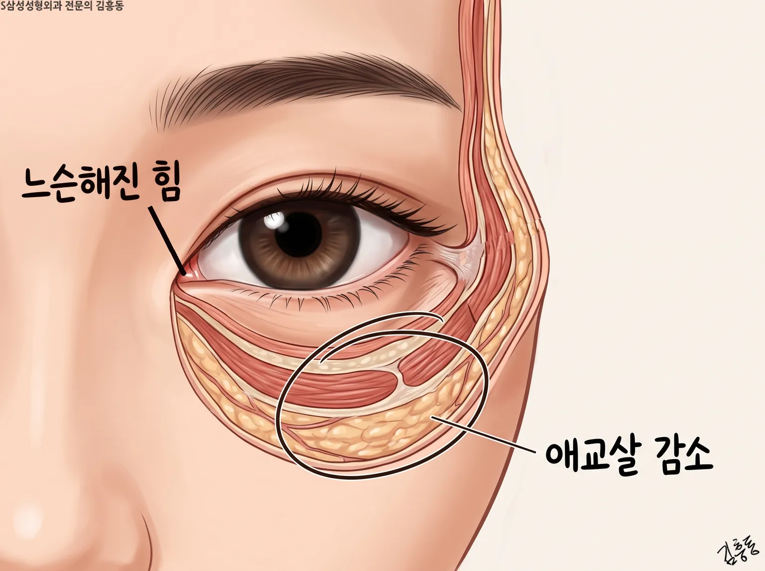 느슨해진 힘과 애교살 감소 이름표가 붙은 아래눈꺼풀 단면 그림