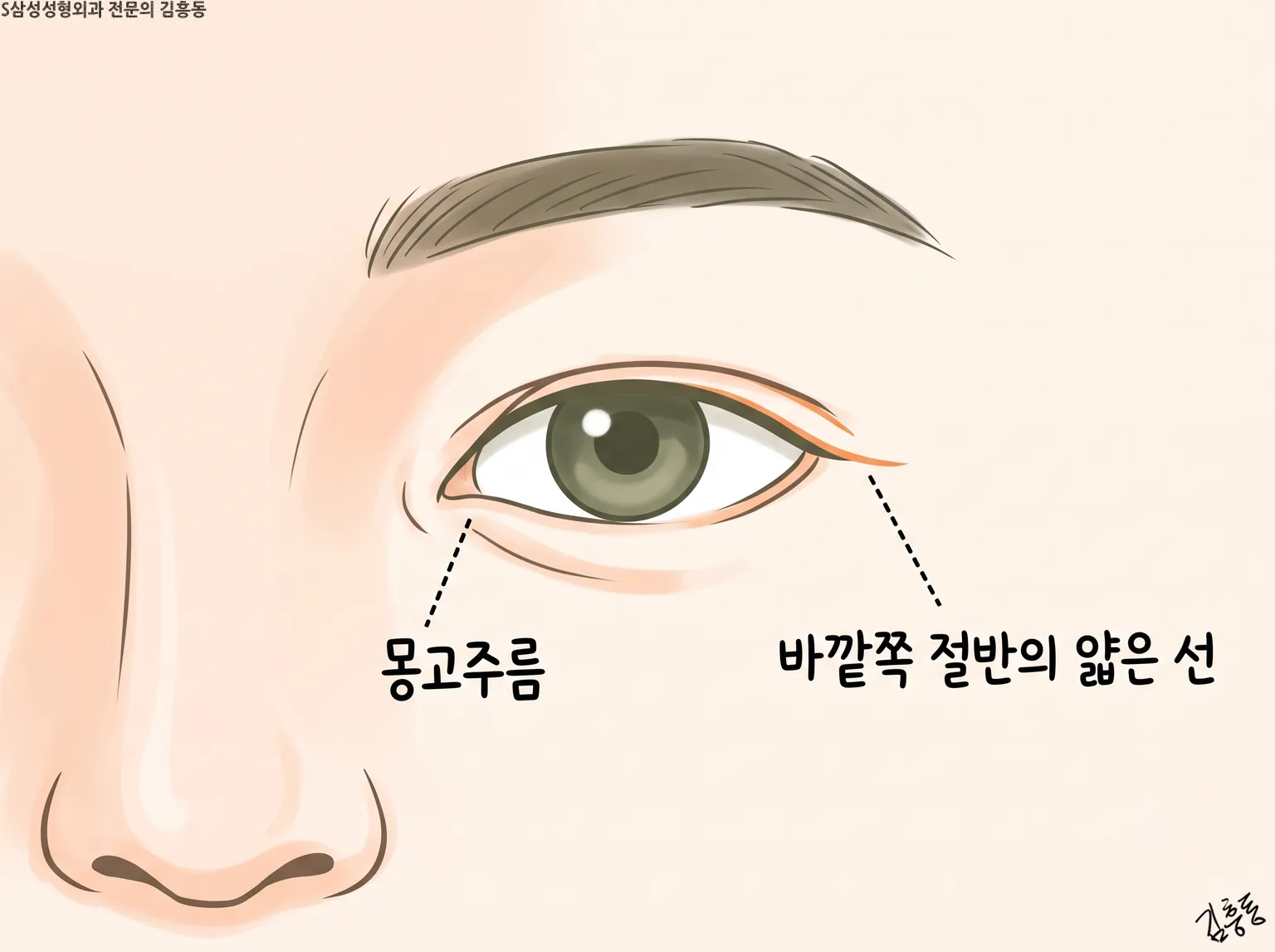 눈 안쪽의 몽고주름과 바깥쪽 절반의 얇은 선을 표시한 한쪽 눈 그림
