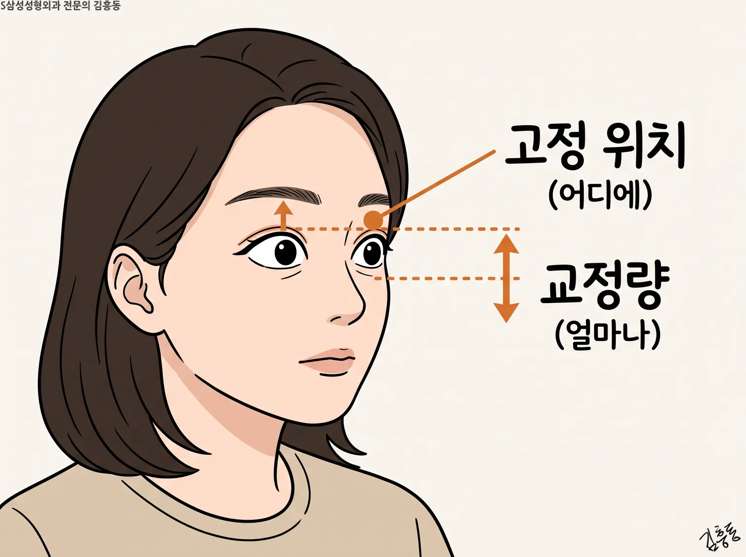 여성 옆얼굴 눈가에 고정 위치(어디에)와 교정량(얼마나)을 점선과 화살표로 나눠 표시한 그림