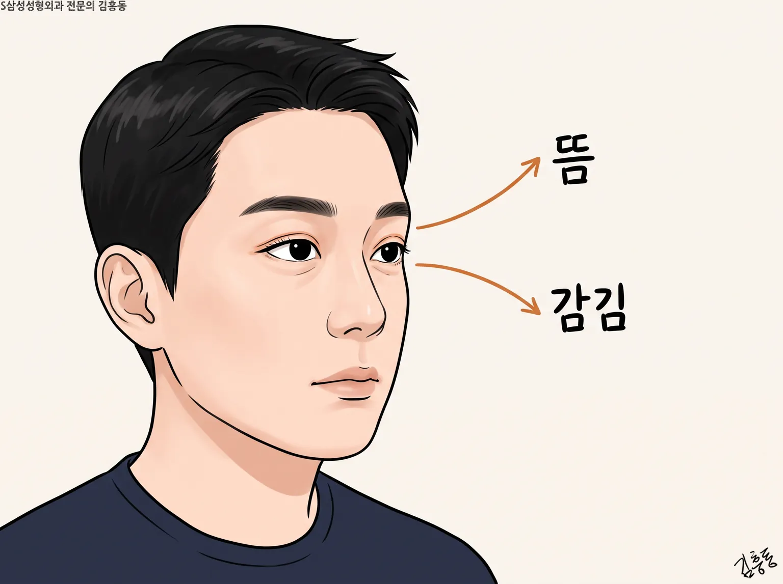 남성 옆얼굴 눈가에서 뜸 · 감김 두 갈래 화살표가 뻗어 나간 그림