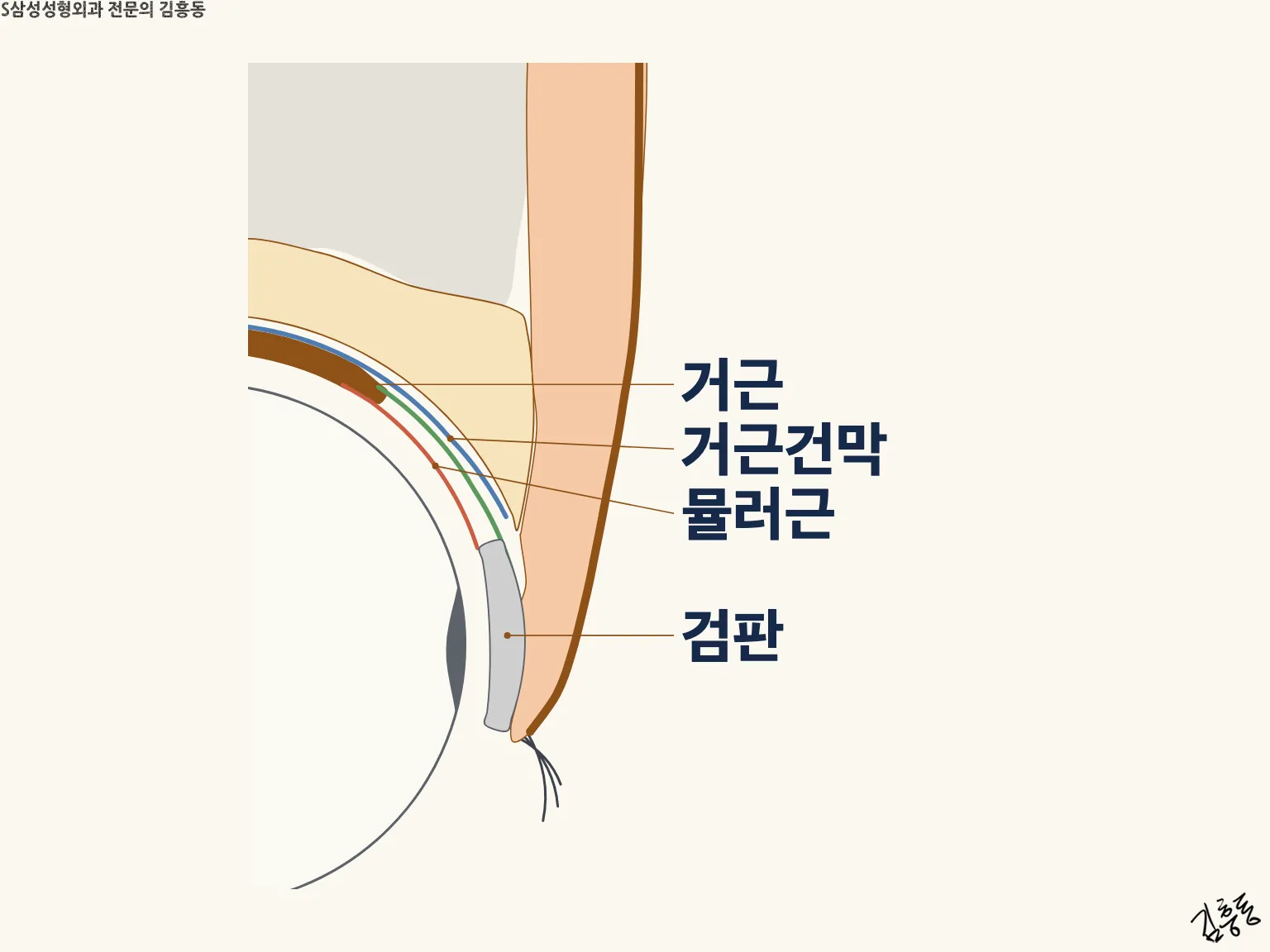 거근 · 거근건막 · 뮬러근 · 검판 이름표가 붙은, 윗눈꺼풀 속 구조를 옆에서 본 단면 그림