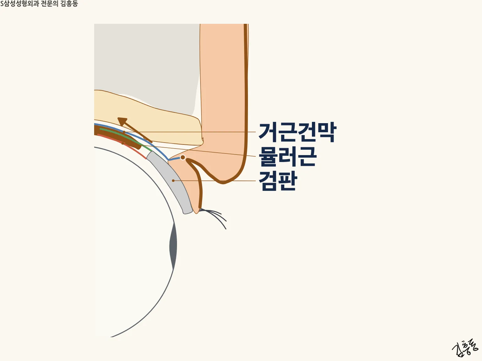 거근건막 · 뮬러근 · 검판 이름표와 위쪽 화살표가 그려진, 윗눈꺼풀 테두리가 올라간 단면 그림