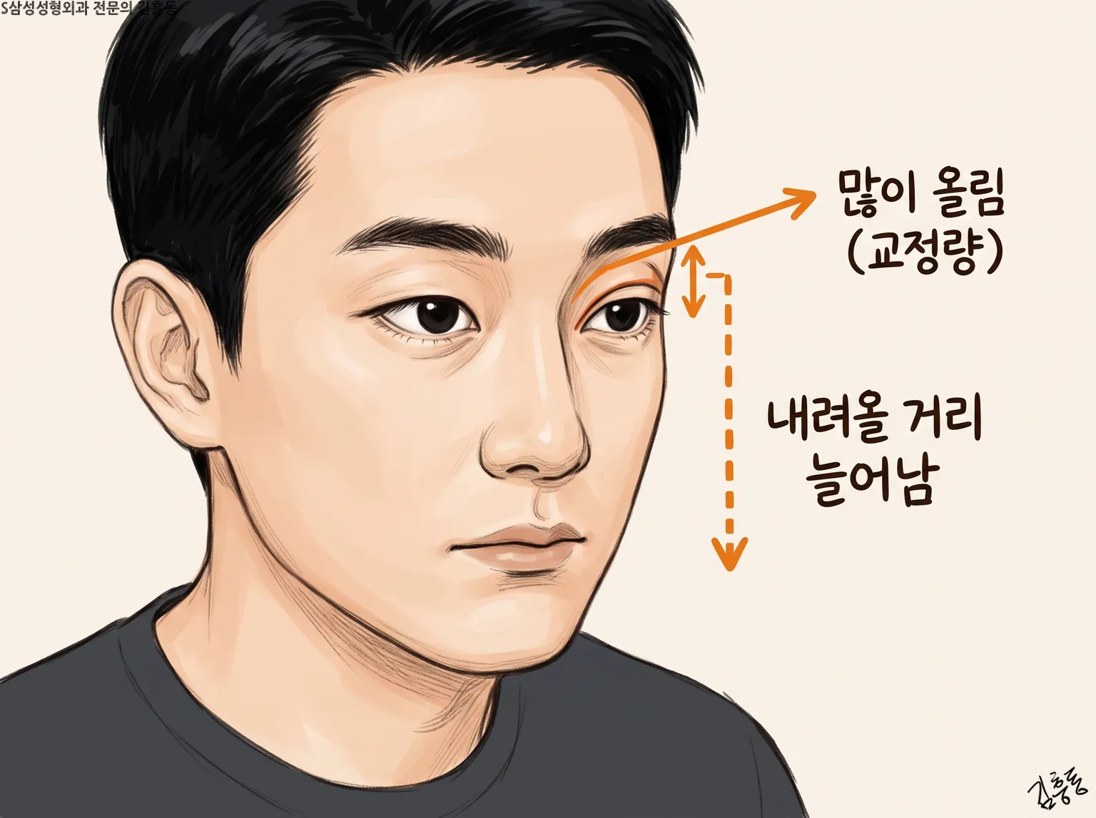 남성 눈가에 많이 올림(교정량)과 내려올 거리 늘어남을 화살표로 표시한 그림