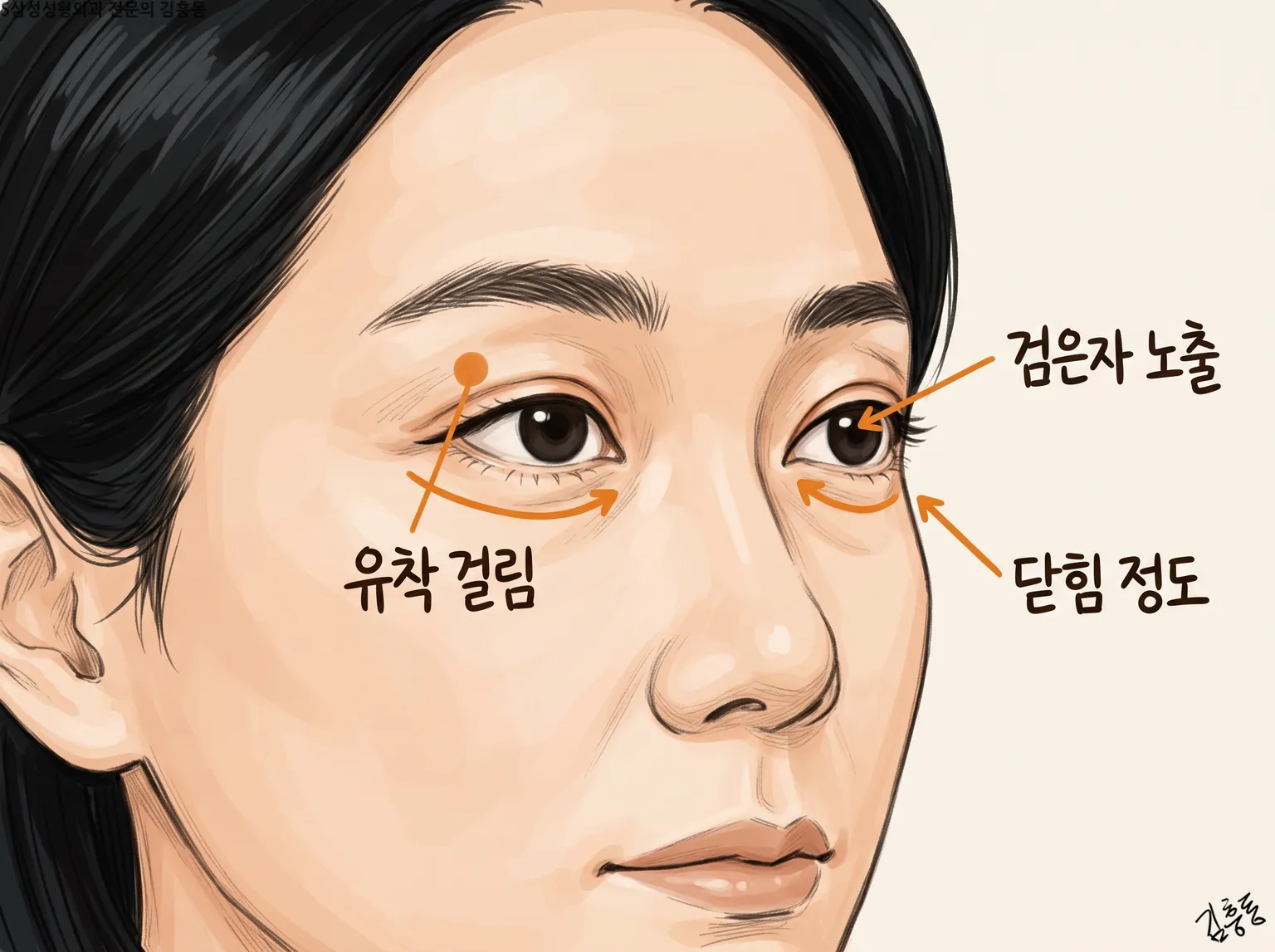 여성 두 눈에 유착 걸림 · 검은자 노출 · 닫힘 정도 이름표와 화살표를 붙인 그림