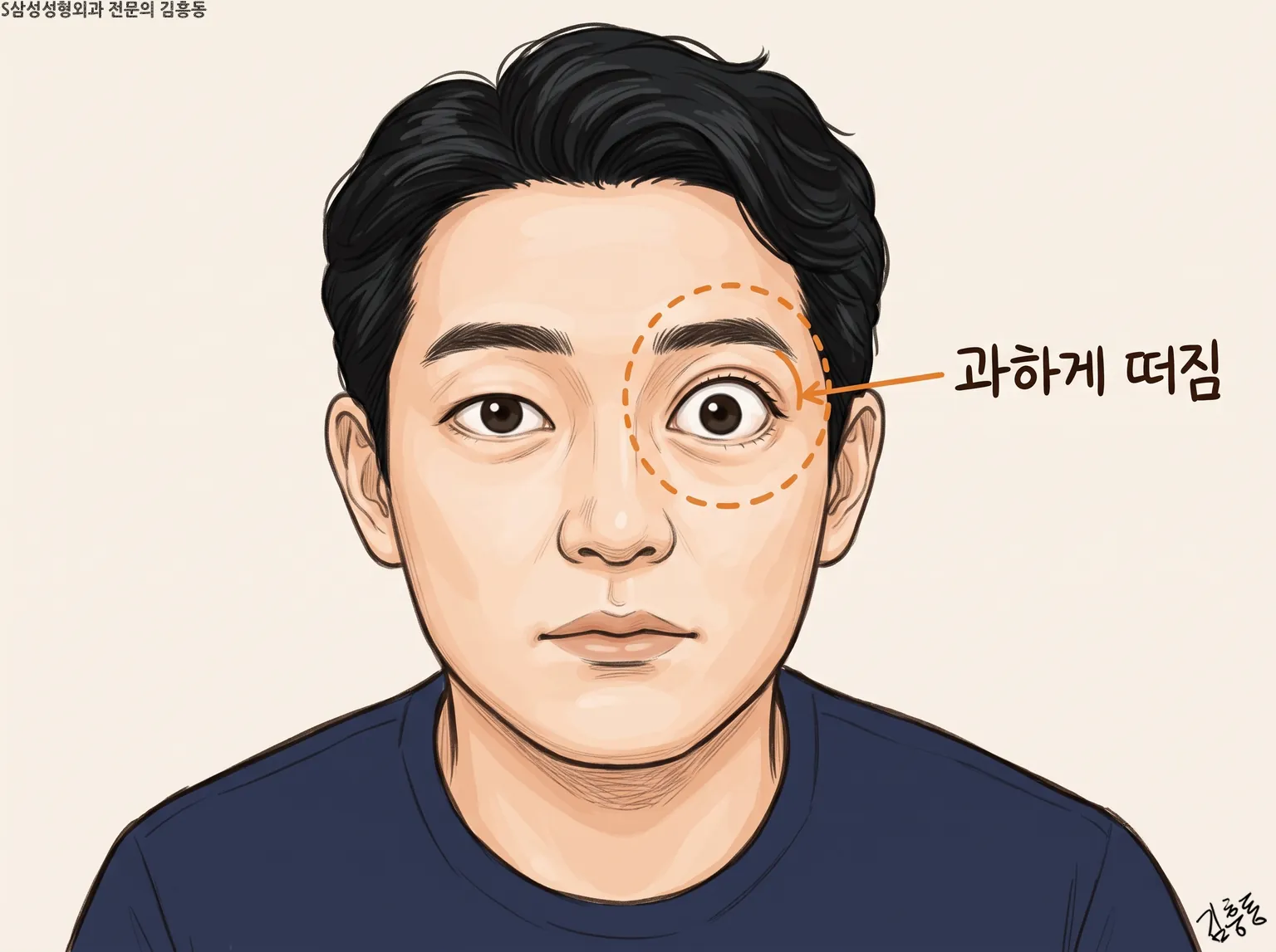 남성 정면 얼굴의 한쪽 눈을 점선 원으로 두르고 과하게 떠짐이라 적은 그림