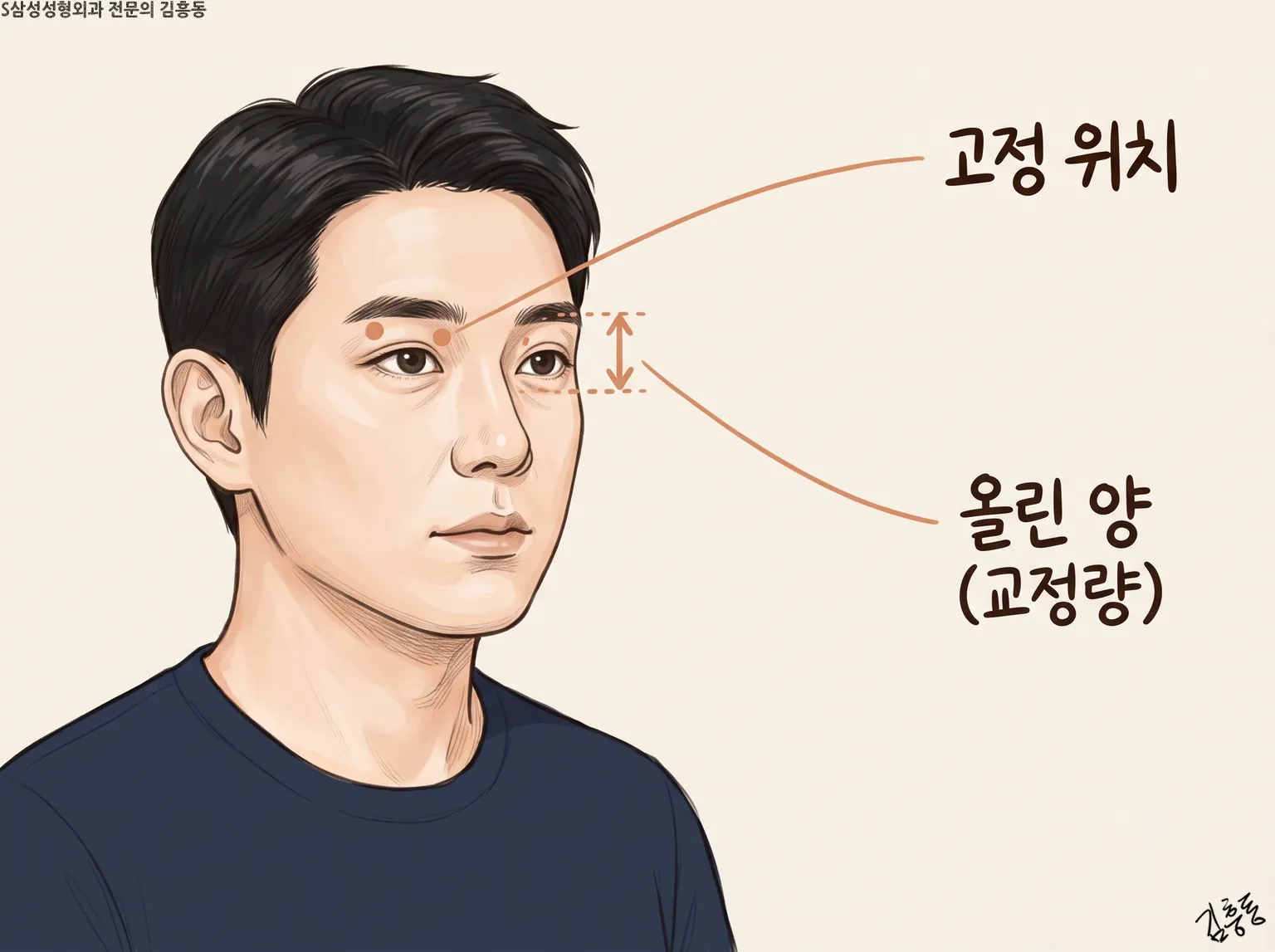 남성 옆얼굴 눈가에 고정 위치와 올린 양(교정량)을 점과 두 눈금 화살표로 보인 그림