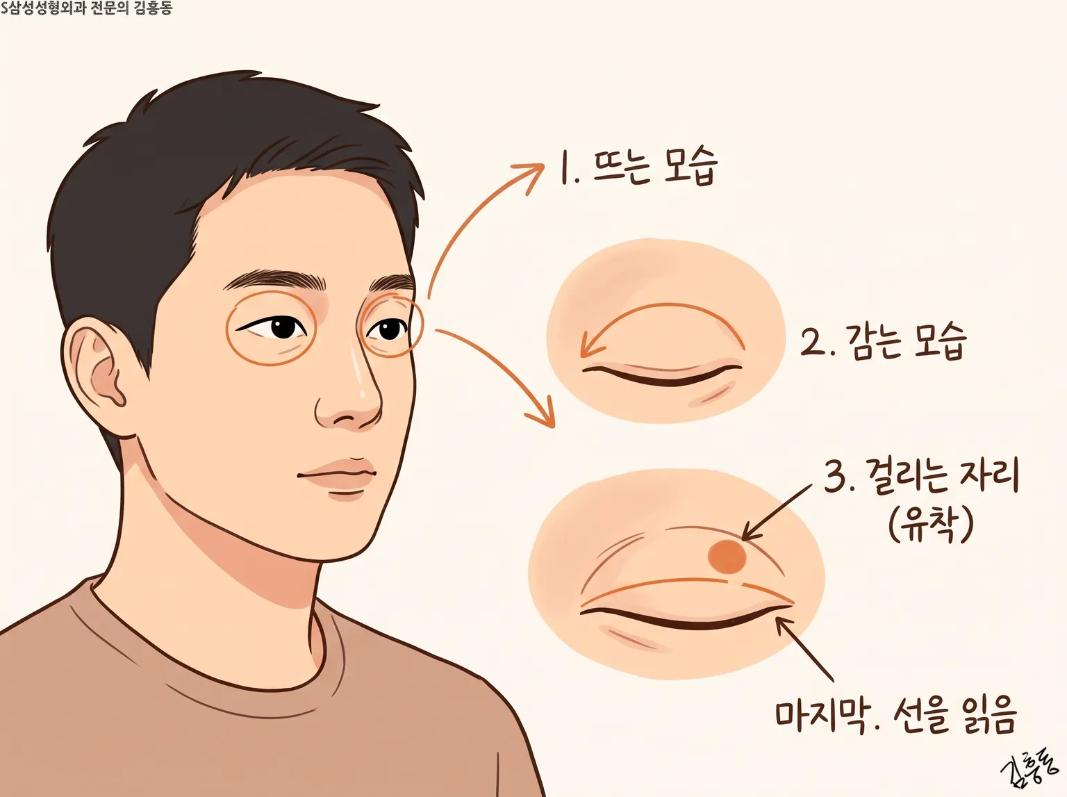남성 눈 옆에 뜨는 모습 · 감는 모습 · 걸리는 자리(유착)를 차례로 확대한 그림