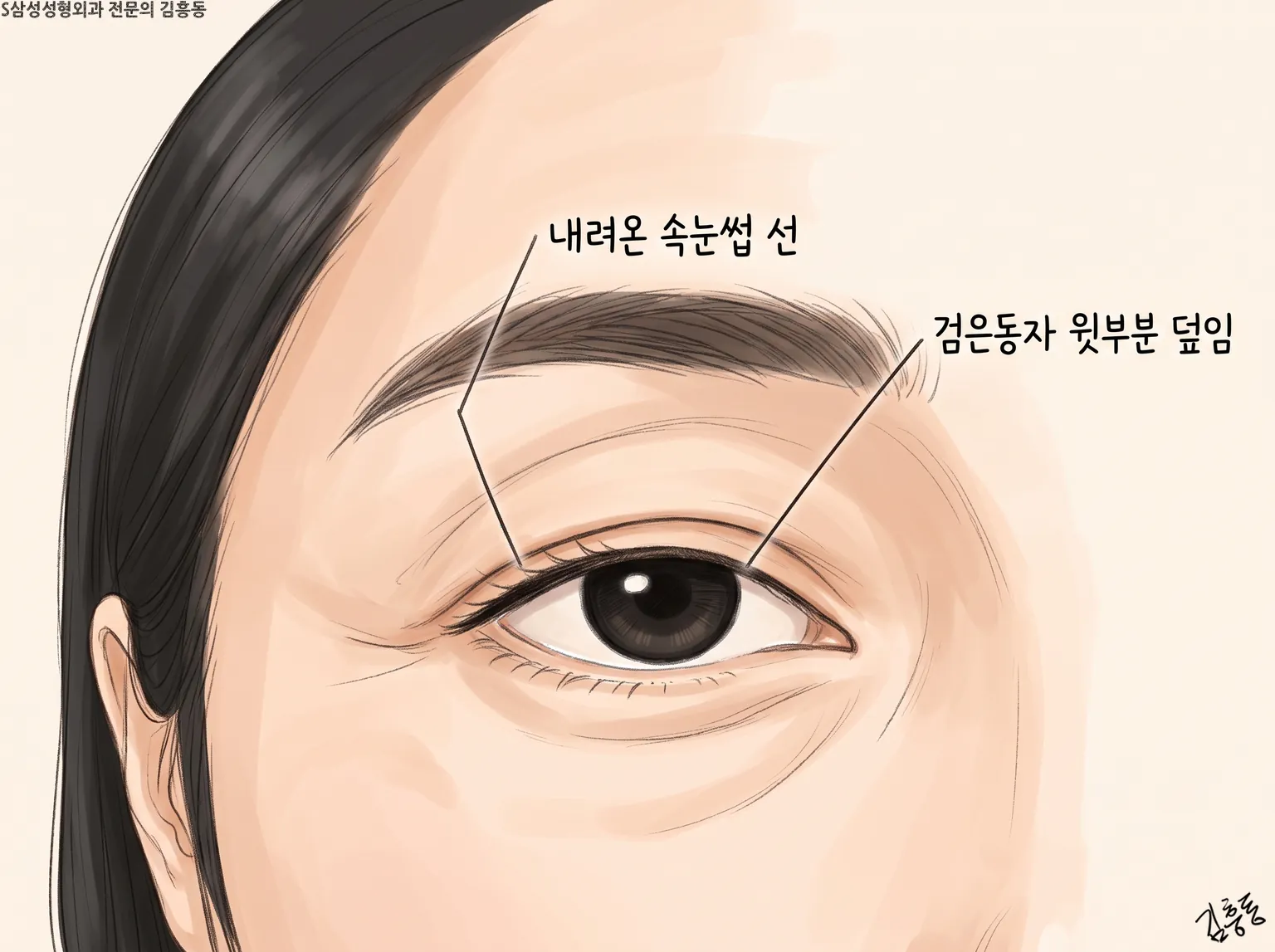 내려온 속눈썹 선과 검은동자 윗부분 덮임을 표시한 한쪽 눈 그림
