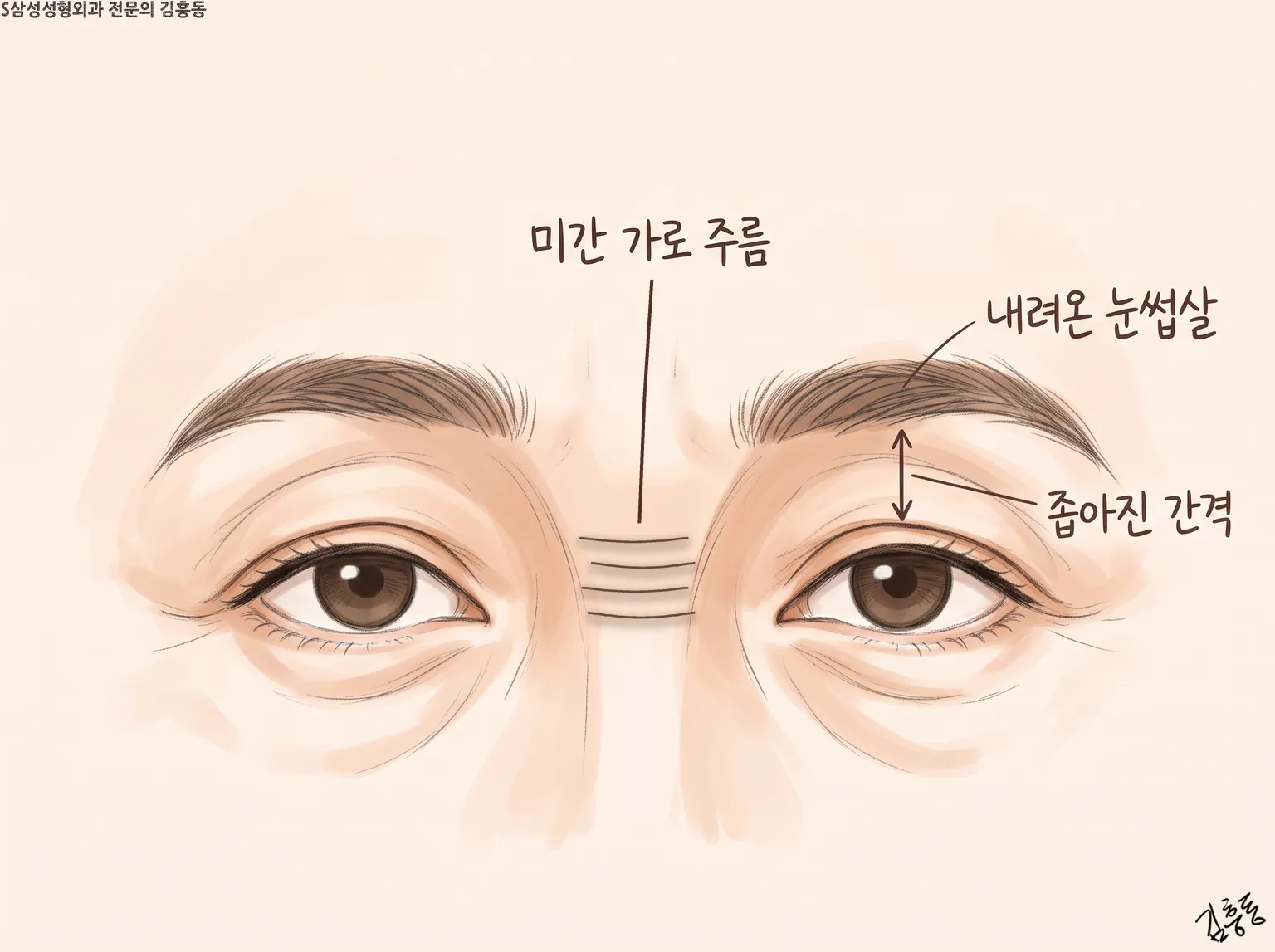 미간 가로 주름 · 내려온 눈썹살 · 좁아진 간격을 표시한 두 눈과 눈썹 그림