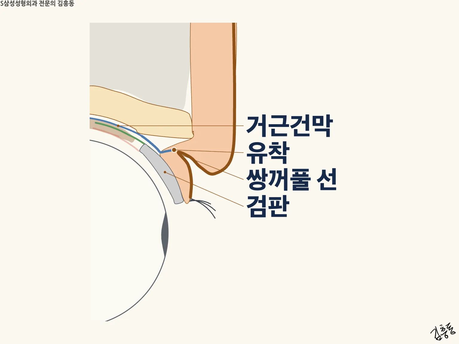 거근건막 · 유착 · 쌍꺼풀 선 · 검판을 표시한 윗눈꺼풀 단면 그림