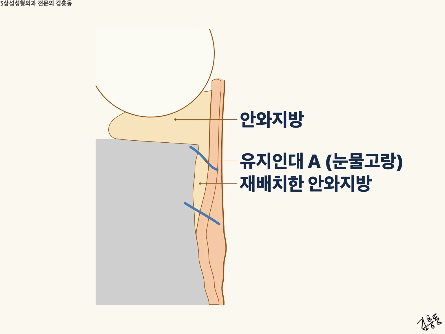 안와지방 · 유지인대 · 재배치한 안와지방 이름표가 붙은 아래눈꺼풀 단면 그림