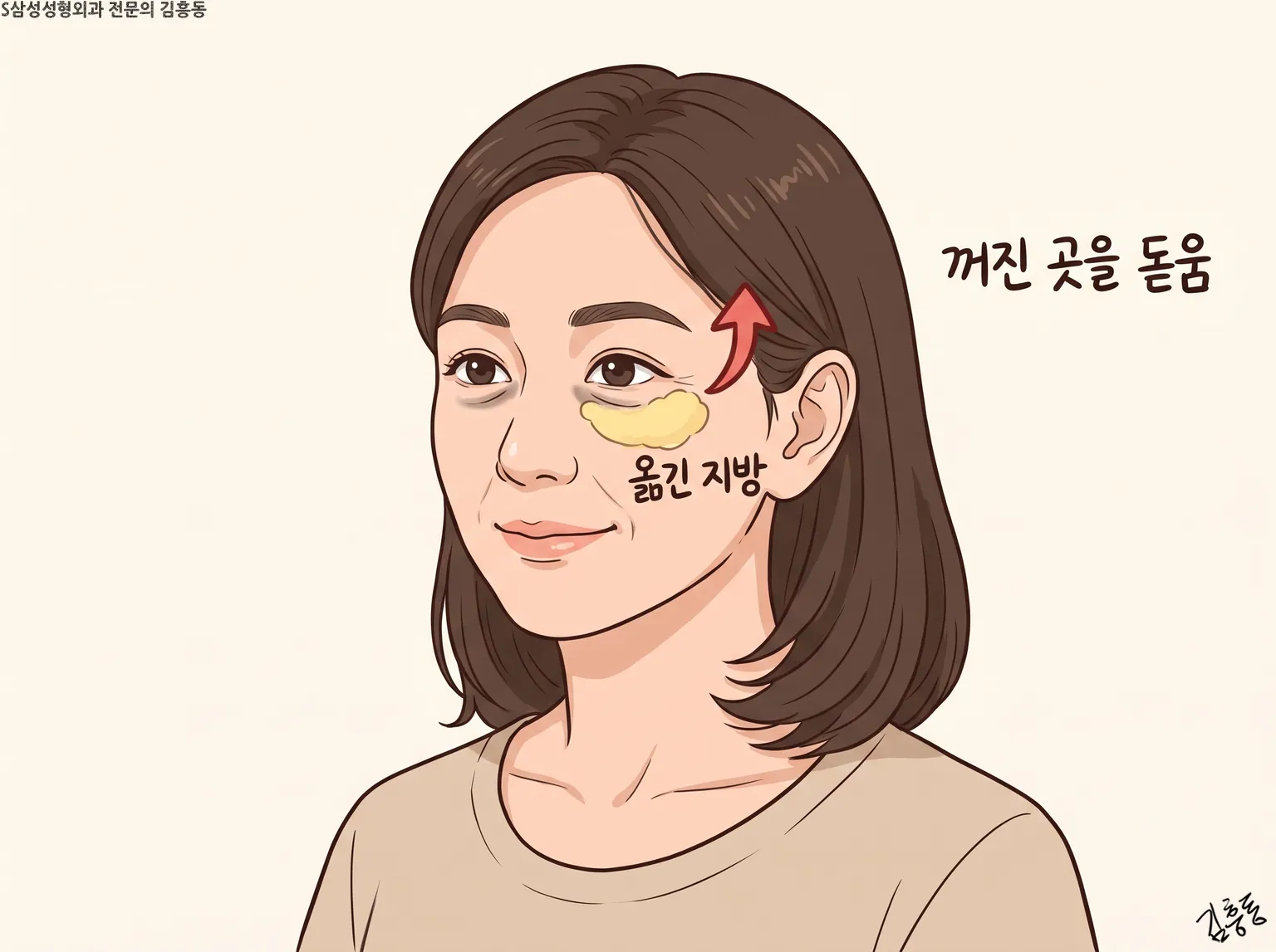 눈밑 옮긴 지방을 노란색으로 칠하고 꺼진 곳을 돋움 이름표를 붙인 만화 얼굴 그림