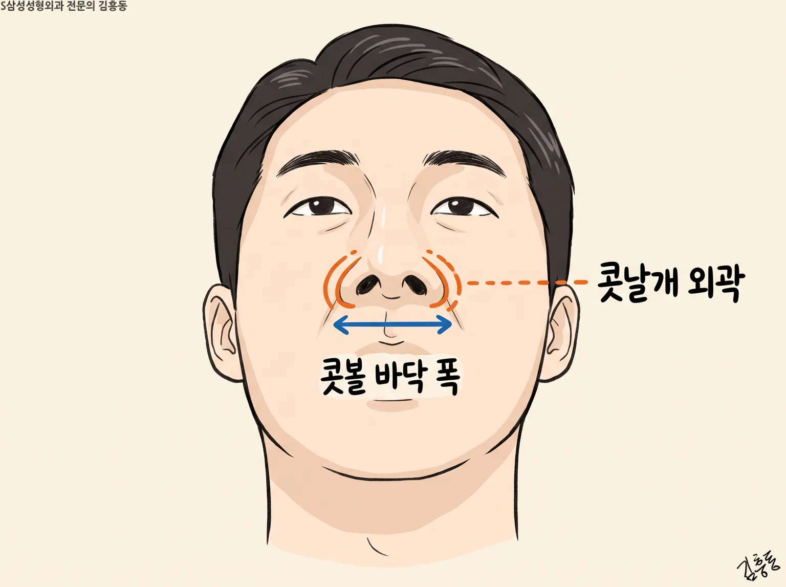 아래에서 본 남성 얼굴에 「콧볼 바닥 폭」 가로 화살표와 「콧날개 외곽」 곡선을 표시한 그림