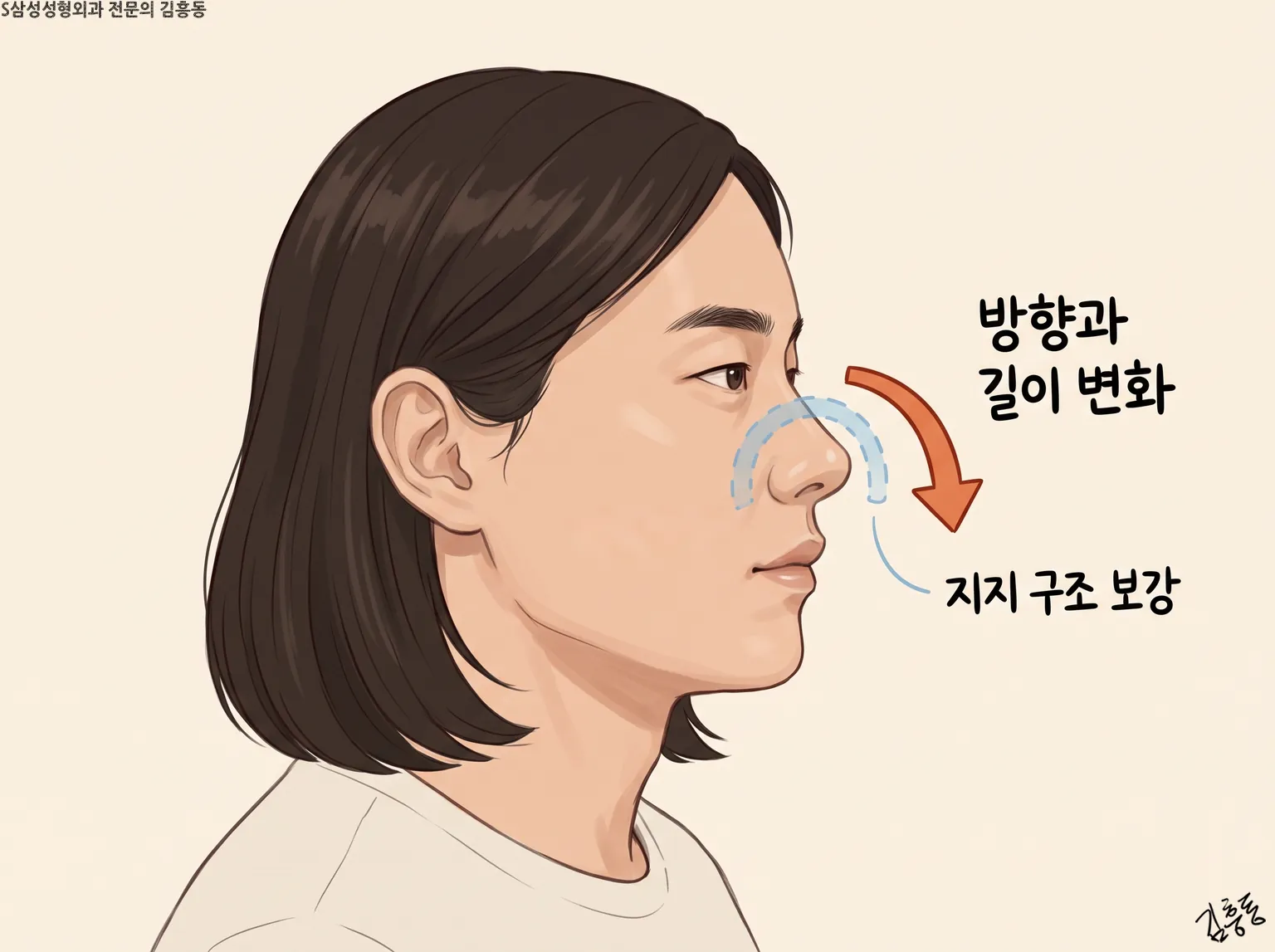 코끝에 「방향과 길이 변화」 곡선 화살표와 「지지 구조 보강」 점선을 그린 여성 옆얼굴 그림