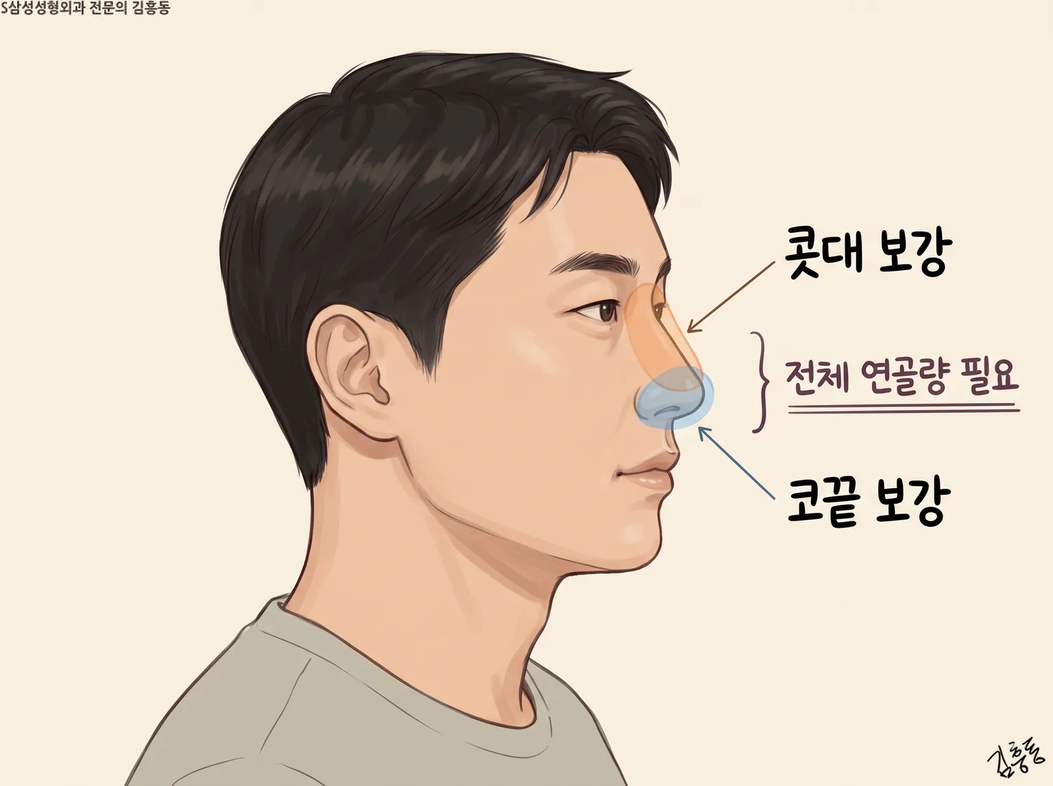 「콧대 보강」 · 「코끝 보강」 자리를 다른 색으로 칠하고 「전체 연골량 필요」라고 적은 남성 옆얼굴 그림