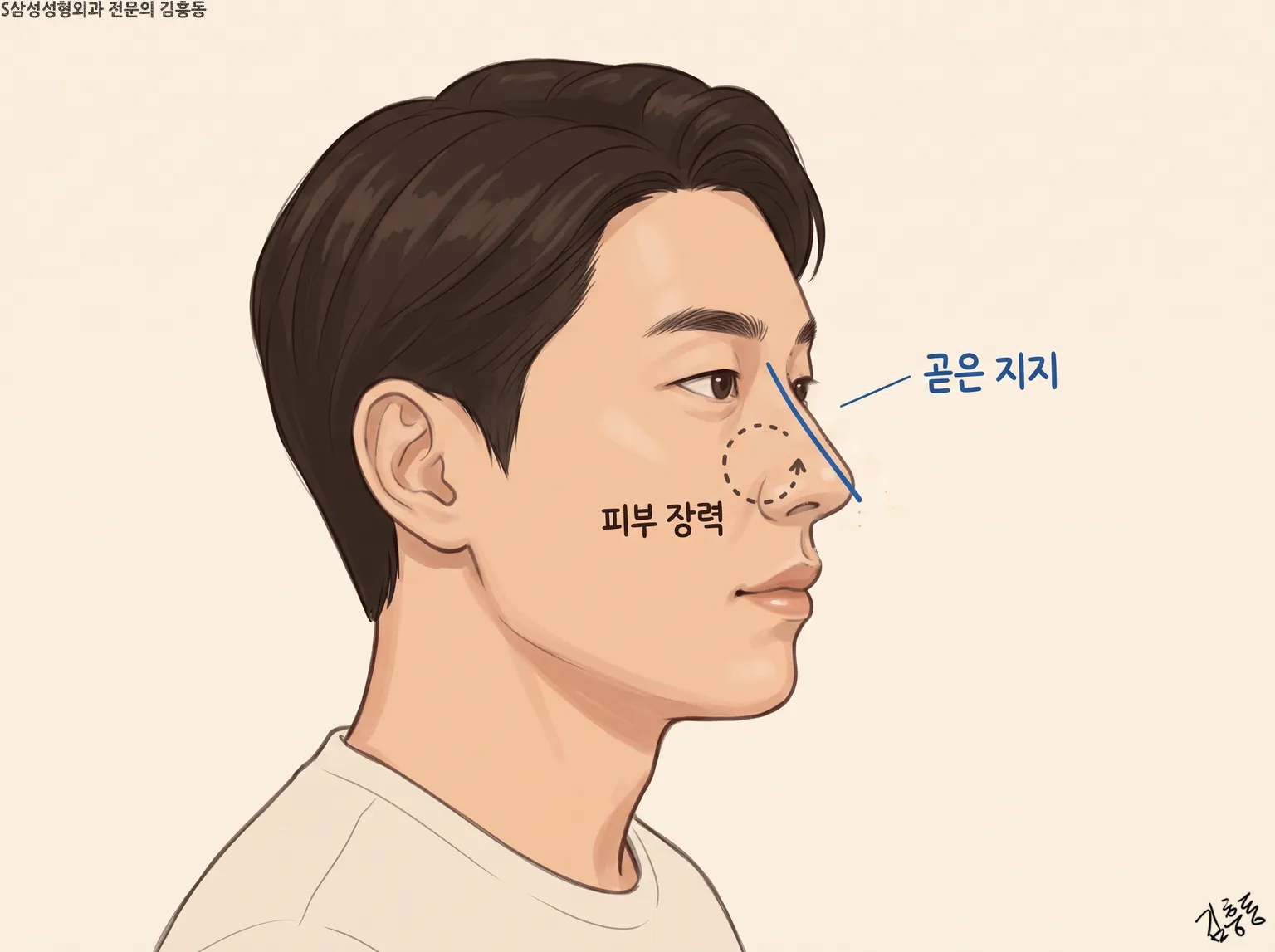 「곧은 지지」 파란 선과 「피부 장력」 점선 동그라미를 표시한 남성 옆얼굴 그림