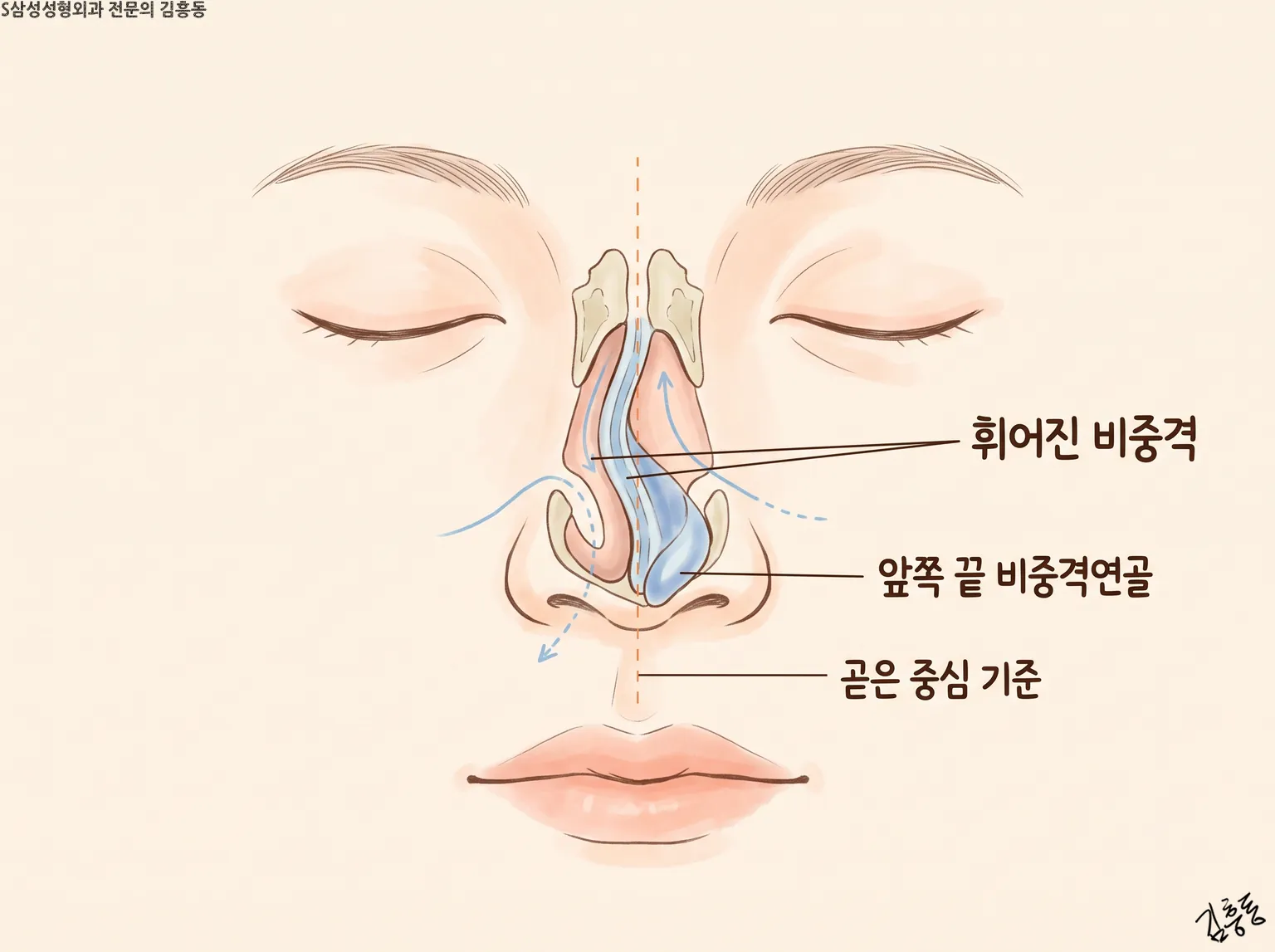 「휘어진 비중격」 · 「앞쪽 끝 비중격연골」 · 「곧은 중심 기준」 이름표가 붙은 코 정면 도식 그림