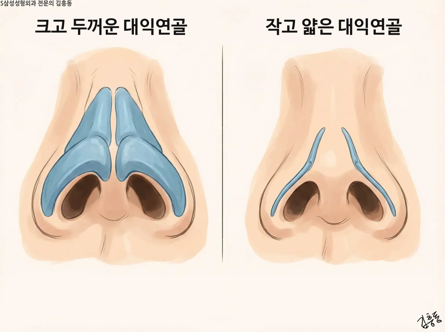 크고 두꺼운 대익연골과 작고 얇은 대익연골을 코 아래에서 본 모양으로 견준 그림